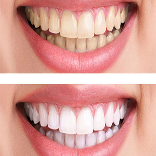 نکاتی برای داشتن دندان های سفیدتر